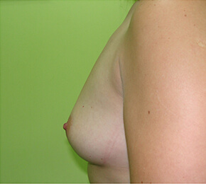 Antes de la operación de aumento de pecho